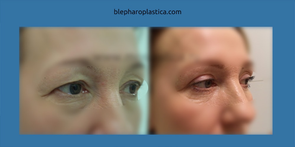 фото: до и после блефаропластики у женщин