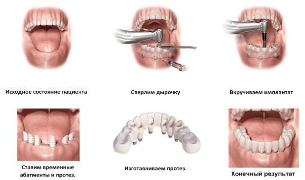 этапы имплантации зубов