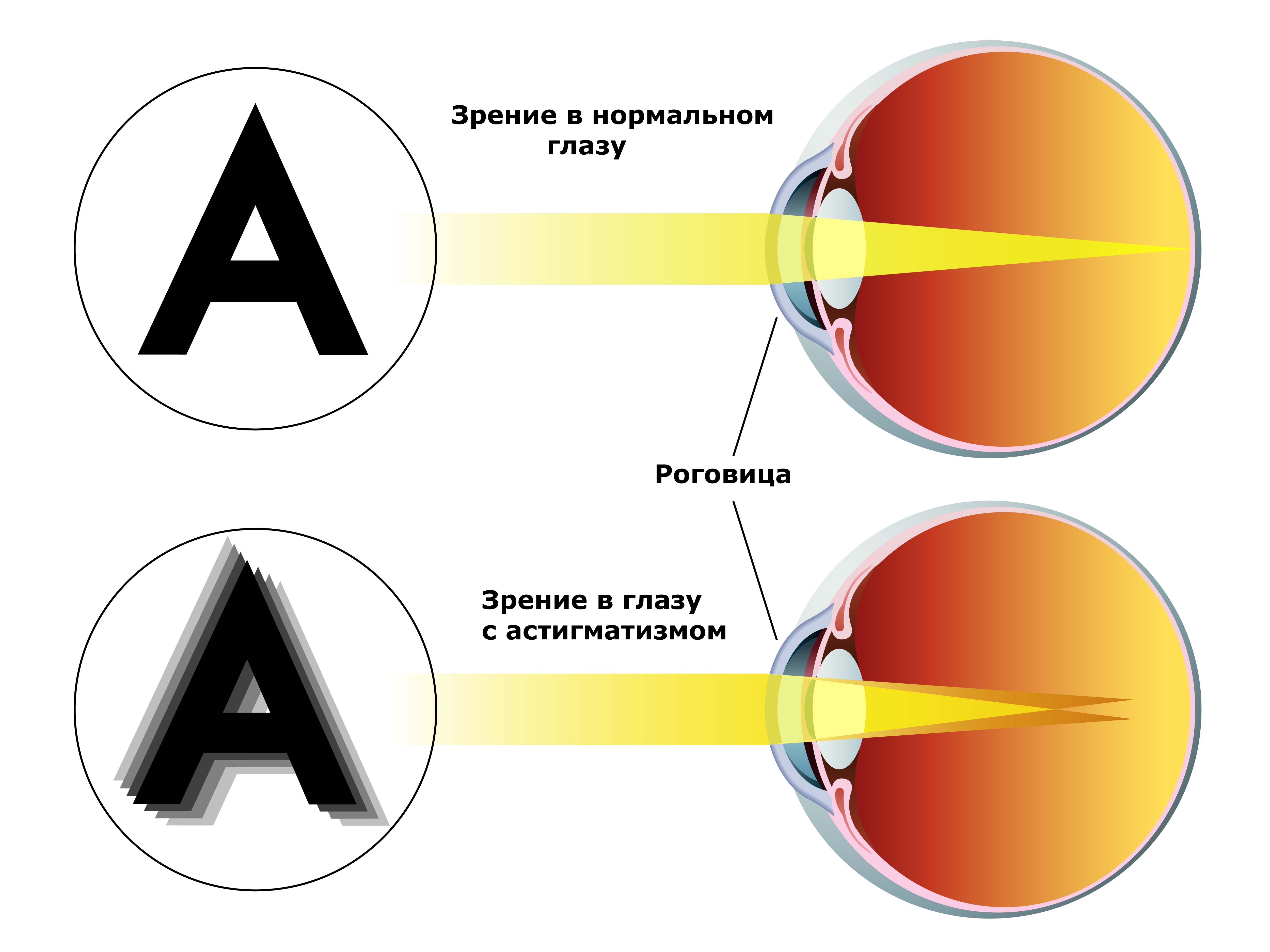 1 зрение это плохо. Астигматизм. Астигматизм глаз. Сложная миопия астигматизм. Заболевание глаз астигматизм.
