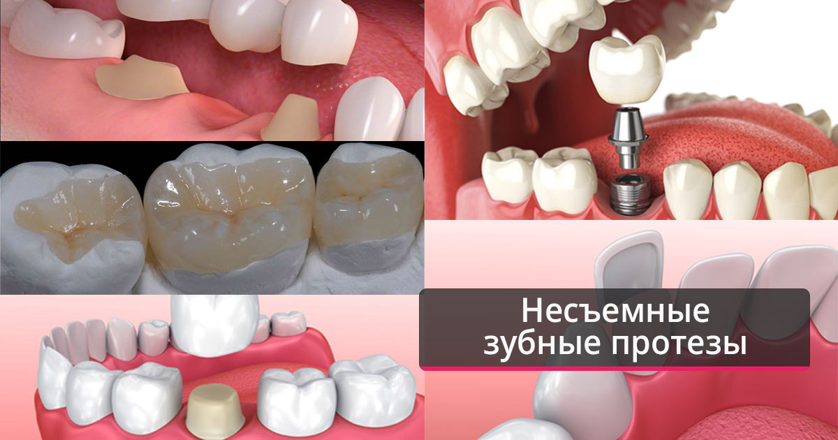 Несъёмное протезирование зубов