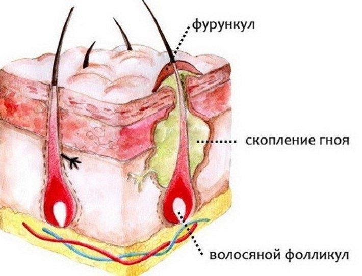 структура фурункула