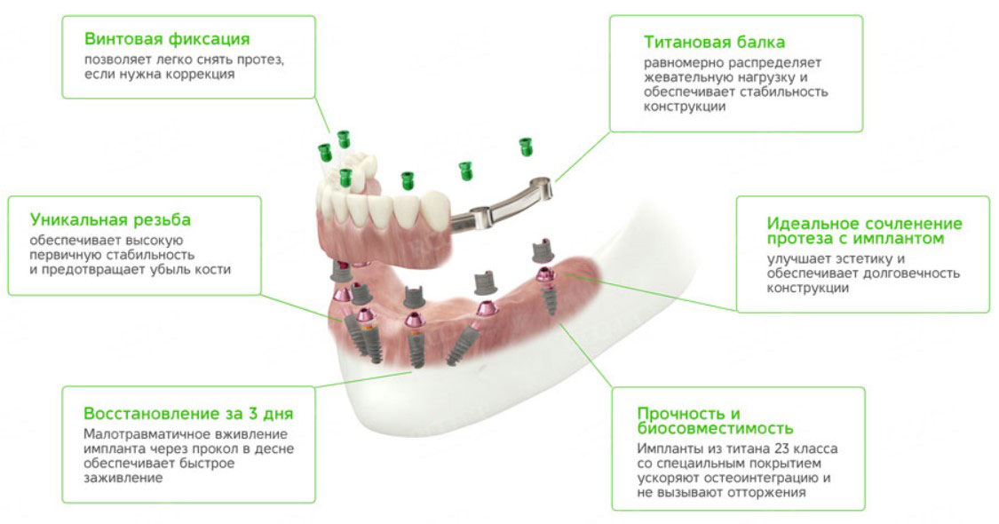 Выбор идеальных протезов зубов: всё, что нужно знать