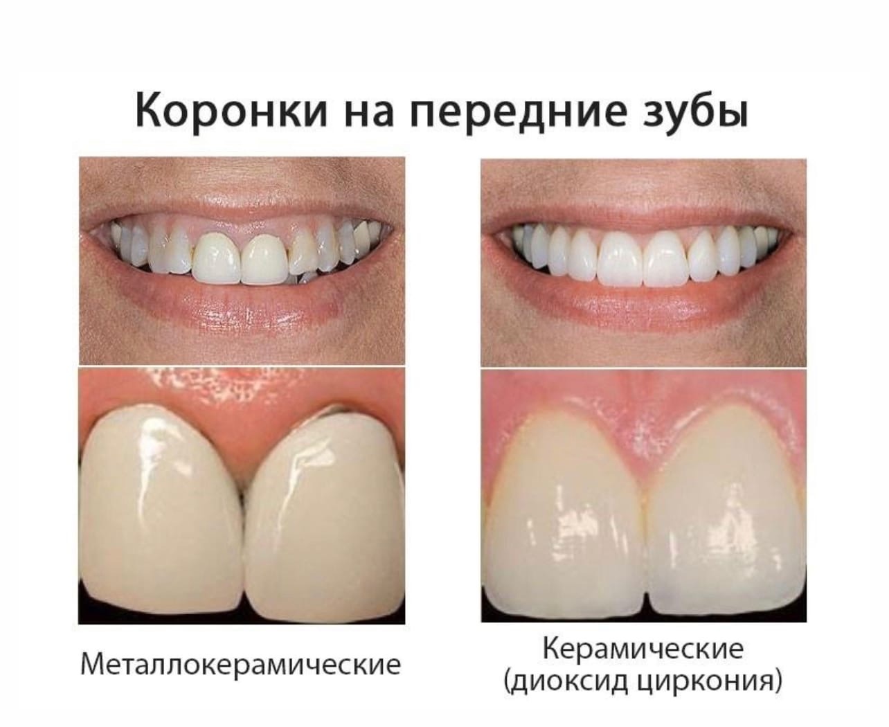 обточка зубов фото