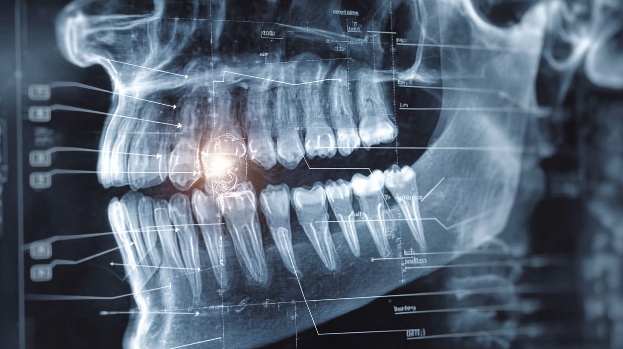 Схема расположения кисты зуба на рентгеновском снимке